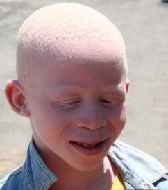 Albino boy in Africa